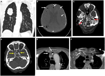 Cerebral air embolism: neurologic manifestations, prognosis, and outcome